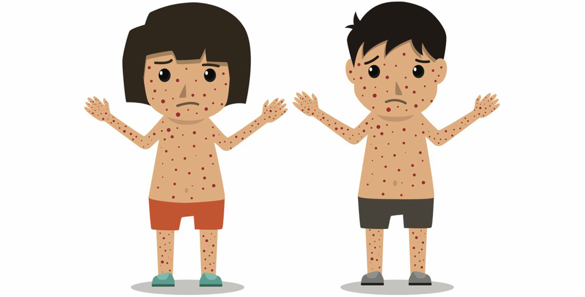 I’ve been exposed to measles. Now what? photo
